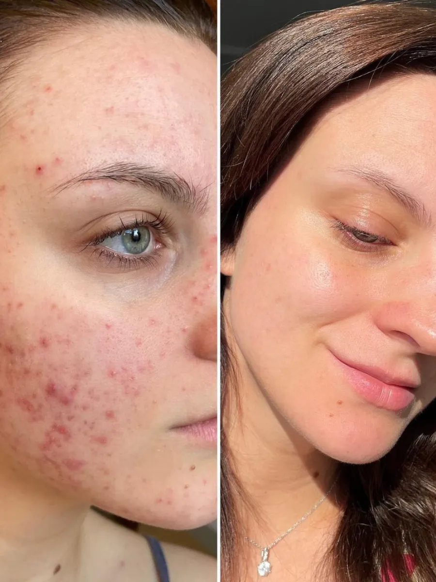 Acne Premium Set