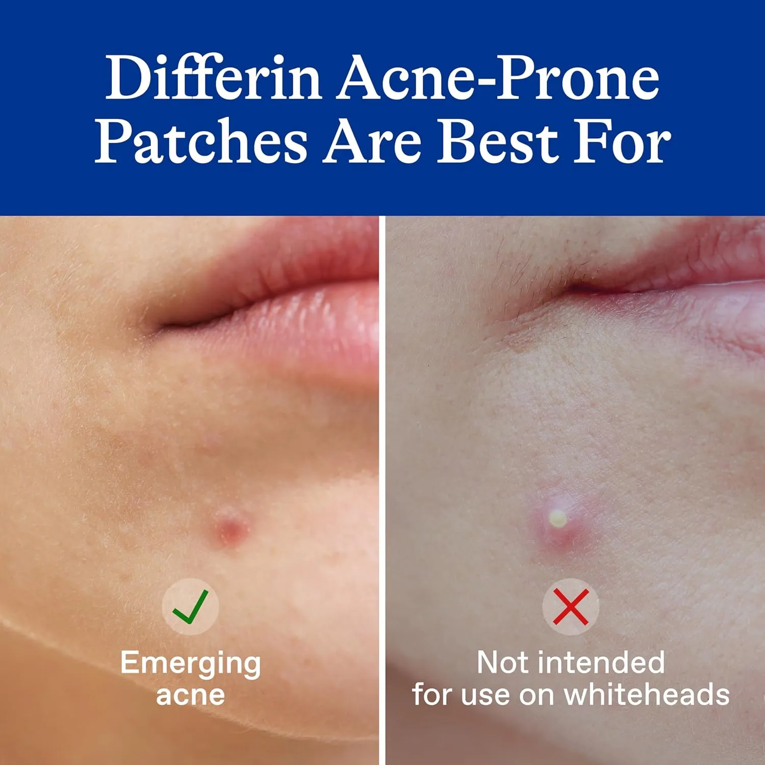 Acne - Prone Skin Patches