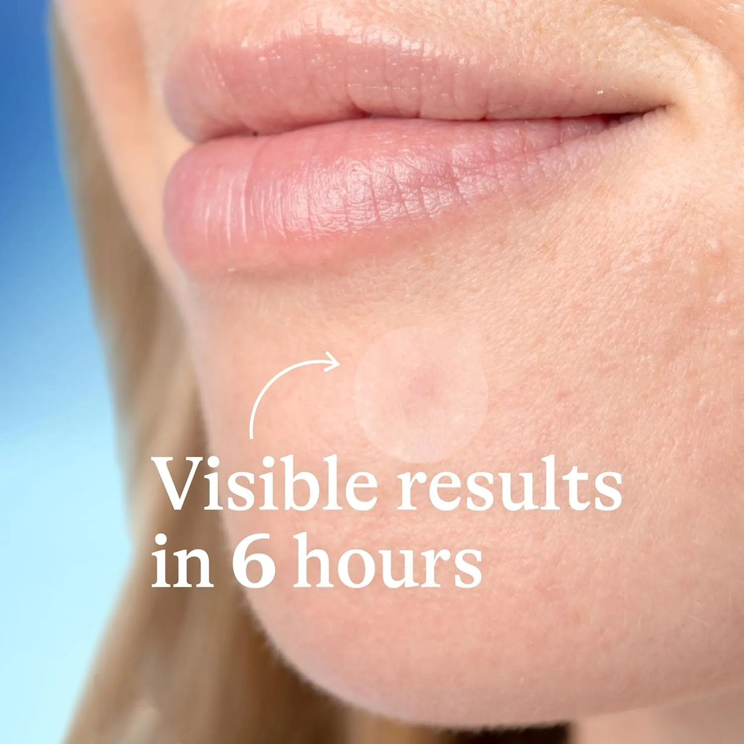 Acne - Prone Skin Patches