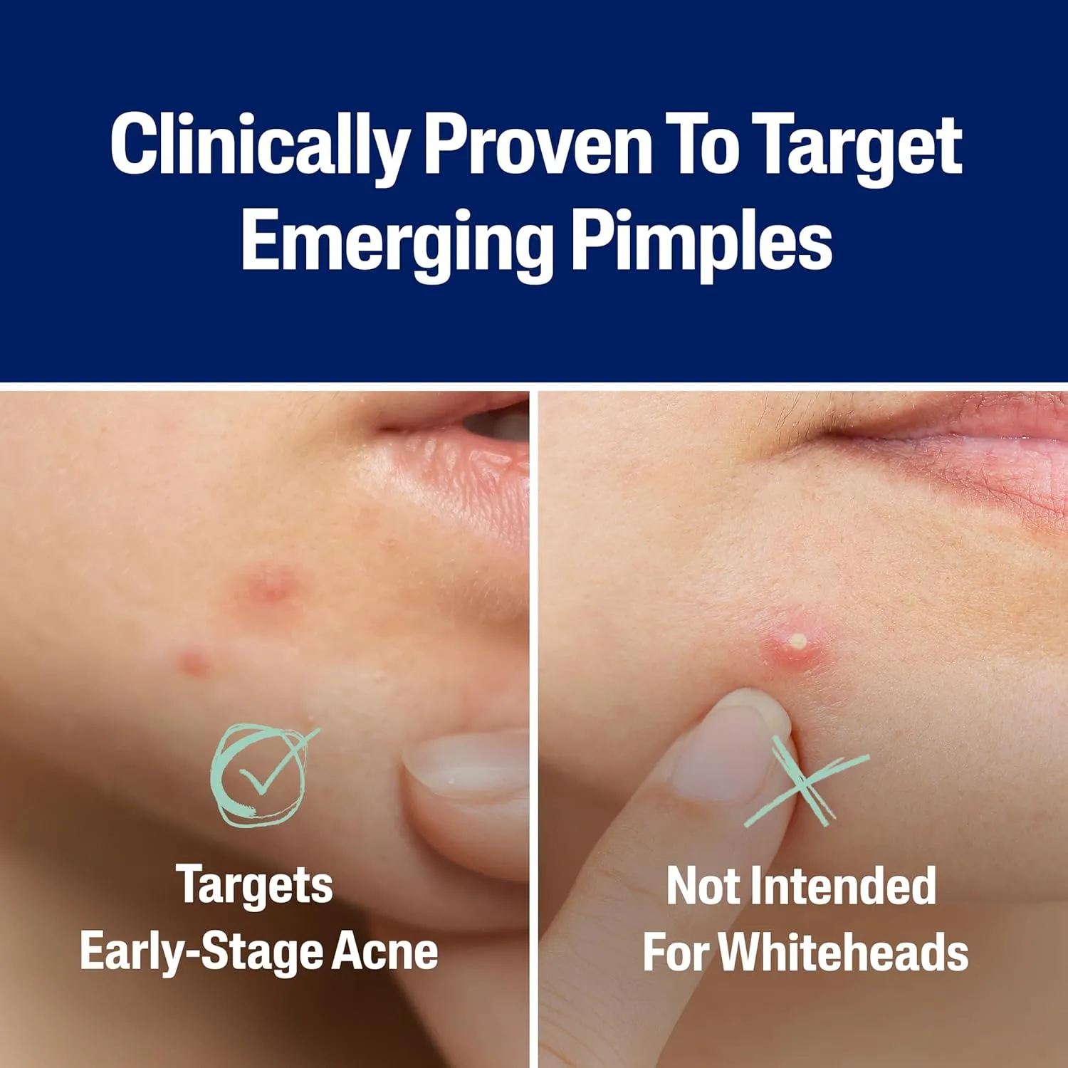 Cetaphil - Acne Patches, Pimple Patches - 24 patches